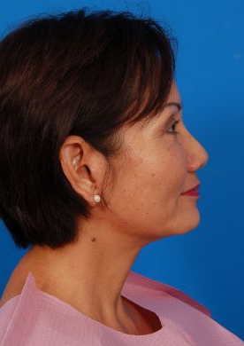 Woman's face, after Brow Lift, Forehead Lift treatment, r-side oblique view, patient 12
