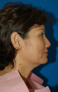 Woman's face, before Brow Lift, Forehead Lift treatment, r-side view, patient 12