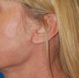 Woman's ear, after Facelift treatment, l-side view, patient 13