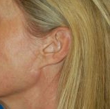 Woman's ear, before Facelift treatment, l-side view, patient 13