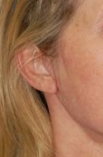Woman's ear, after Facelift treatment, r-side oblique view, patient 13