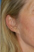 Woman's ear, before Facelift treatment, r-side oblique view, patient 13