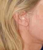 Woman's ear, after Facelift treatment, r-side view, patient 13