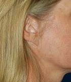Woman's ear, before Facelift treatment, r-side view, patient 13