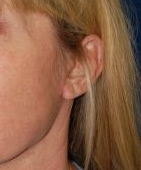 Woman's ear, after Facelift treatment, l-side oblique view, patient 13