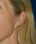 Woman's ear, before Facelift treatment, l-side oblique view, patient 13