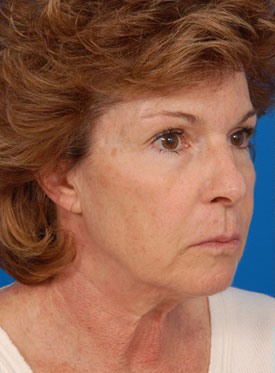Woman's face, before Facelift treatment, r-side oblique view, patient 2