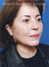 Woman's face, after Facelift treatment, r-side oblique view, patient 4