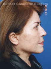 Woman's face, after Facelift treatment, r-side view, patient 4