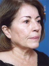 Woman's face, before Facelift treatment, r-side oblique view, patient 4