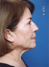 Woman's face, before Facelift treatment, r-side view, patient 4