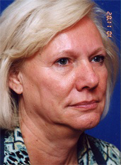 Woman's face, before Facelift treatment, r-side oblique view, patient 5