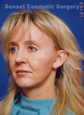 Woman's face, after Facelift treatment, l-side oblique view, patient 6