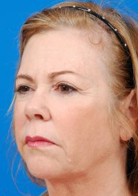 Woman's face, after Facelift treatment, l-side oblique view, patient 7