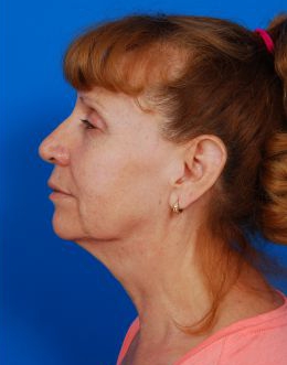Woman's face, before Facelift treatment, l-side view, patient 8