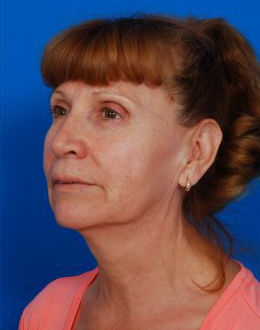 Woman's face, before Facelift treatment, l-side oblique view, patient 8