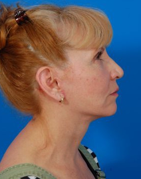 Woman's face, after Facelift treatment, r-side view, patient 8