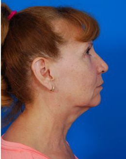 Woman's face, before Facelift treatment, r-side view, patient 8