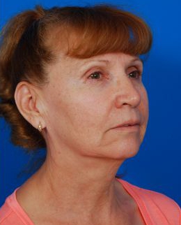 Woman's face, before Facelift treatment, r-side oblique view, patient 8