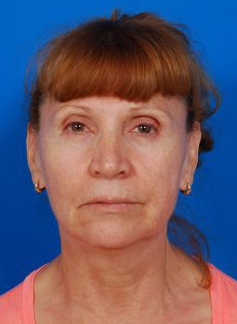 Woman's face, before Facelift treatment, front view, patient 8