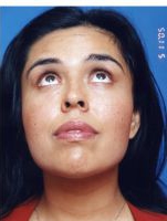 Woman's face, after 7 weeks Facial Fat Grafting treatment, front view, patient 1