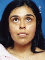 Woman's face, before Facial Fat Grafting treatment, front view, patient 1