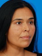 Woman's face, after Facial Fat Grafting treatment, r-side oblique view - patient 1