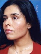 Woman's face, after Facial Fat Grafting treatment, l-side oblique view, patient 1