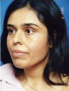 Woman's face, before Facial Fat Grafting treatment, l-side oblique view, patient 1