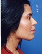 Woman's face, after Facial Fat Grafting treatment, r-side view, patient 1