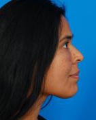 Woman's face, after Facial Fat Grafting treatment, r-side view - patient 1