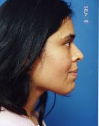 Woman's face, before Facial Fat Grafting treatment, r-side view, patient 1