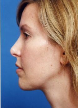 Woman's face, after Facial Fat Grafting treatment, l-side view, patient 11