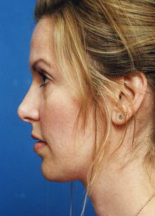 Woman's face, before Facial Fat Grafting treatment, l-side view, patient 11
