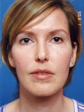 Woman's face, after Facial Fat Grafting treatment, front view, patient 11