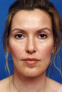 Woman's face, before Facial Fat Grafting treatment, front view, patient 11
