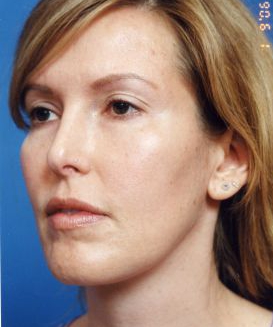 Woman's face, after Facial Fat Grafting treatment, l-side oblique view, patient 11