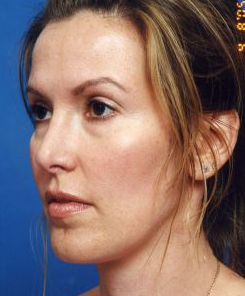 Woman's face, before Facial Fat Grafting treatment, l-side oblique view, patient 11