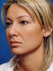 Woman's face, after Facial Fat Grafting treatment, l-side oblique view, patient 5