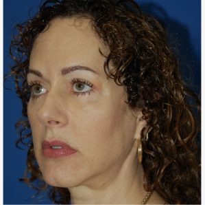 Woman's face, after Facial Fat Grafting treatment, l-side oblique view, patient 6