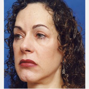 Woman's face, before Facial Fat Grafting treatment, l-side oblique view, patient 6