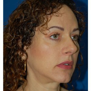 Woman's face, after Facial Fat Grafting treatment, r-side oblique view, patient 6