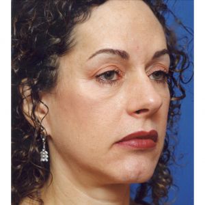 Woman's face, before Facial Fat Grafting treatment, r-side oblique view, patient 6