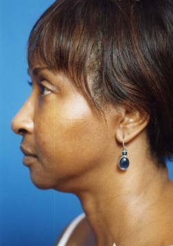 Woman's face, after Facial Fat Grafting treatment, l-side view - patient 7