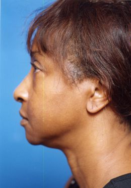 Woman's face, before Facial Fat Grafting treatment, l-side view - patient 7