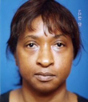 Woman's face, before Facial Fat Grafting treatment, front view, patient 7