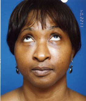 Woman's face, after Facial Fat Grafting treatment, front view (eyes looks up), patient 7