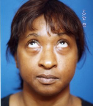 Woman's face, before Facial Fat Grafting treatment, front view (eyes looks up), patient 7