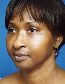 Woman's face, after Facial Fat Grafting treatment, l-side view, patient 7