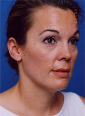 Woman's face, before Facial Fat Grafting treatment, r-side oblique view, patient 8